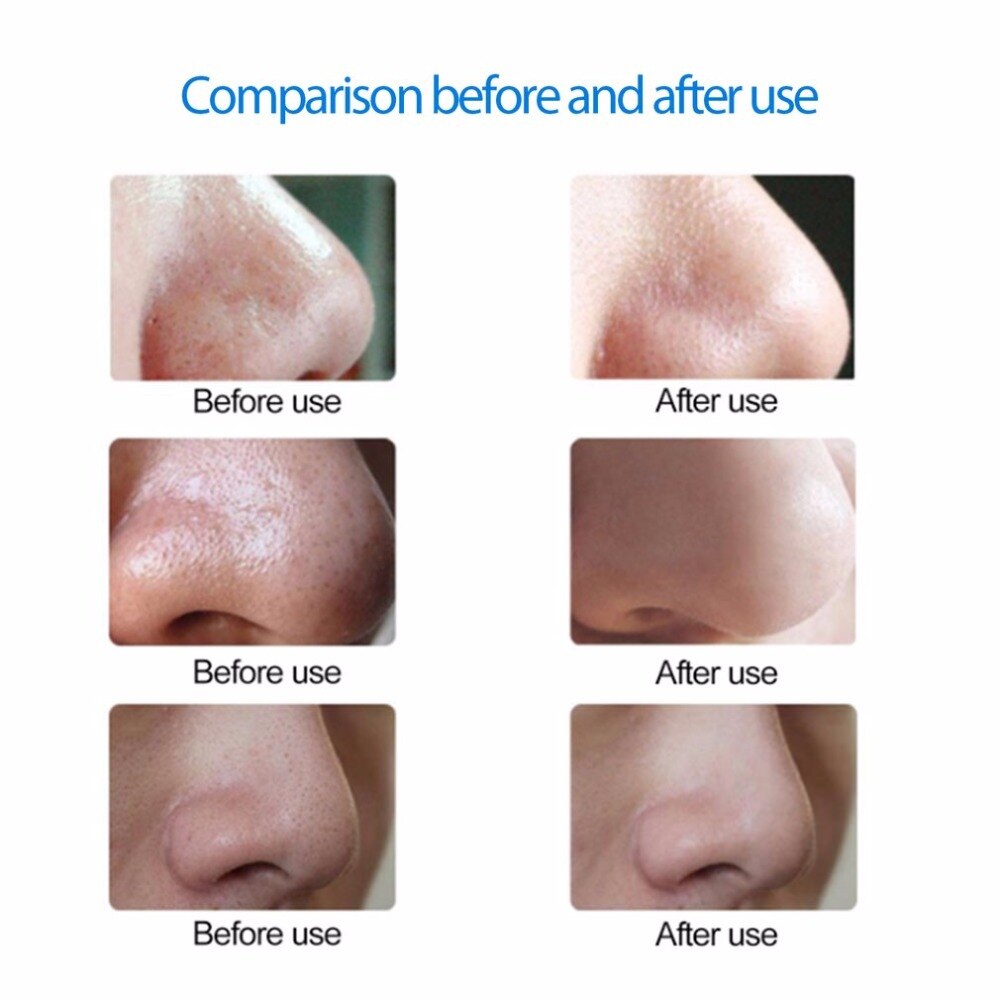 Electric Blackhead Vacuum Suction Facial Pore Spot Cleaner Face Dirt Suck Up Vacuum Acne Pimple Remover Beauty Skin Care Tool - ebowsos