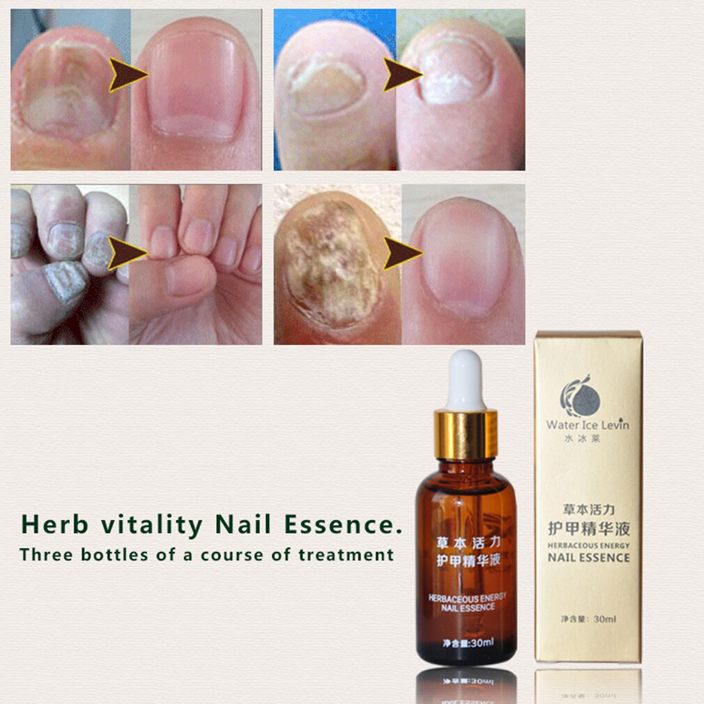 New 30ml Fungal Nail Treatment Essence Oil Feet Care Nail Polish Tools Nail Gel Armor Essence Toe Nail Fungus Removal - ebowsos