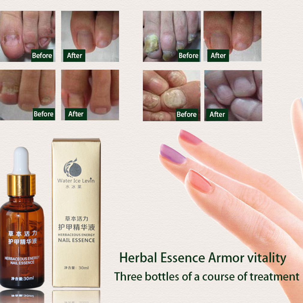 New 30ml Fungal Nail Treatment Essence Oil Feet Care Nail Polish Tools Nail Gel Armor Essence Toe Nail Fungus Removal - ebowsos